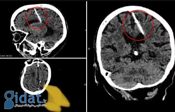 ۸۰ سال زندگی یک زن با سوزنی در مغزش