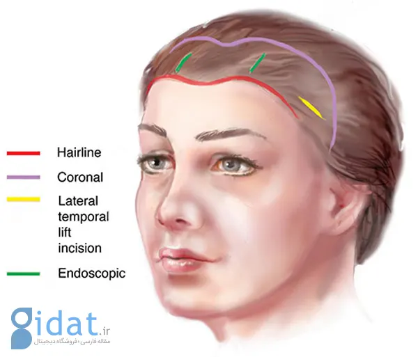لیفت پیشانی و ﺍبرو چیست و به چه روش‌هایی انجام می شود؟