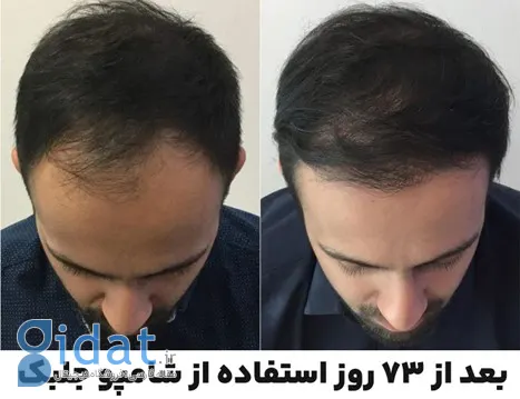 خبر فوری: این شامپوها شما را کچل می‌کنند!