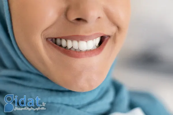سفید کردن دندان 5 روش پزشکی و 10 روش خانگی سفید کردن دندان