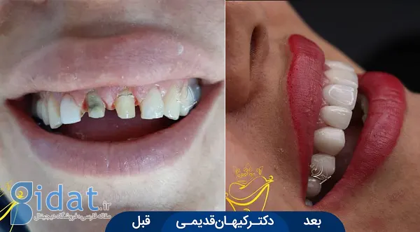 لمینت کریستال دندان چیست و چه ویژگی هایی دارد؟