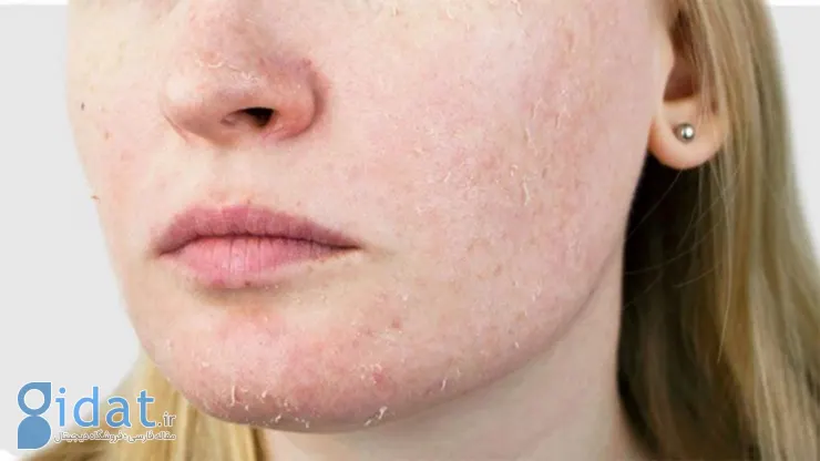 Dry-skin-winter-1024x576