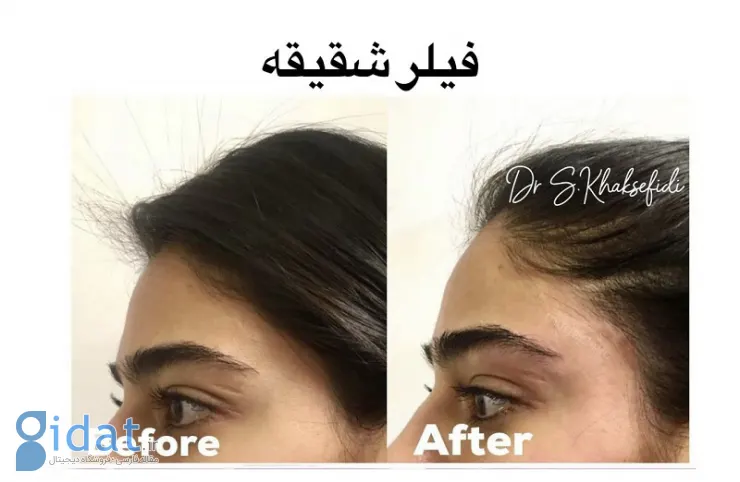 بهترین پزشک برای تزریق فیلر شقیقه کیست؟ + لیست 10 پزشک برتر