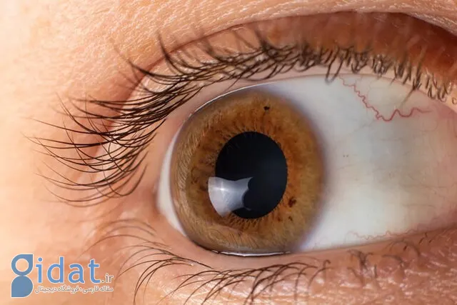 6 بیماری مهمی که چشم ها نسبت به آن هشدار می دهند