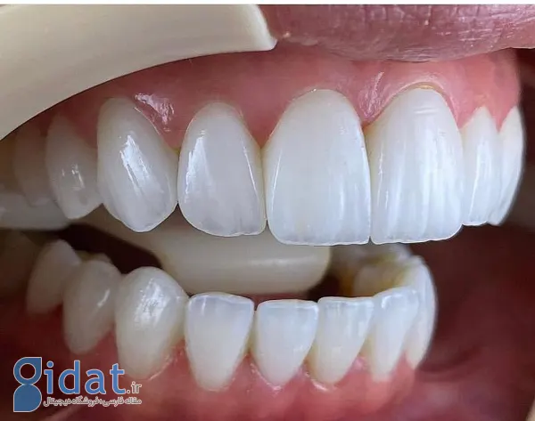 لمینت دندان به صورت اقساطی (پیش و اقساطی)