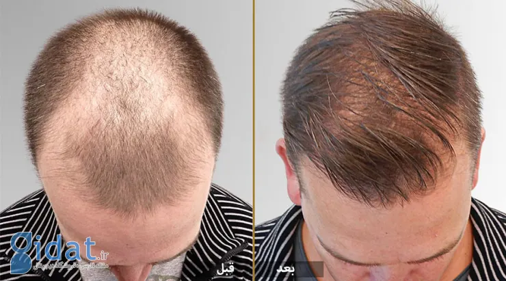 درمان ریزش مو با سلول‌های بنیادی چگونه انجام می‌شود؟