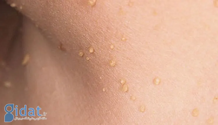 روش‌های از بین بردن خال و زائده‌های گوشتی