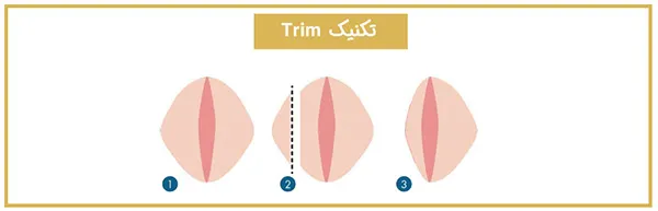 عمل لابیاپلاستی چیست و با چه روش‌هایی انجام می‌شود؟ 