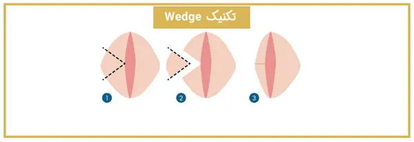 عمل لابیاپلاستی چیست و با چه روش‌هایی انجام می‌شود؟ 