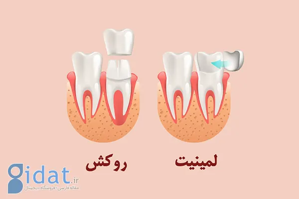 بررسی کامل مزایا و معایب لمینت دندان