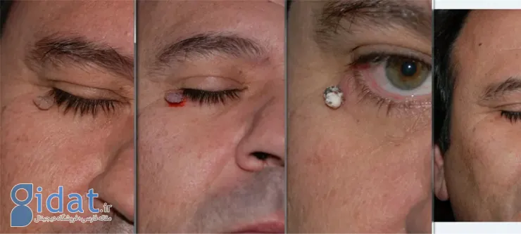 مراقبت های پس از فریز کردن خال گوشتی