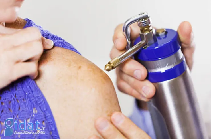 فریز کردن خال گوشتی چگونه انجام می شود؟