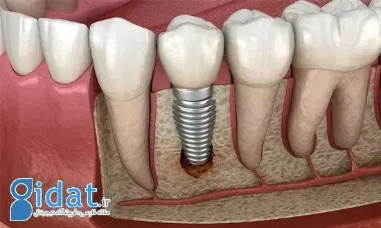 مدت زمان ایمپلنت دندان چقدر است؟ آیا ایمپلنت مادام العمر است؟