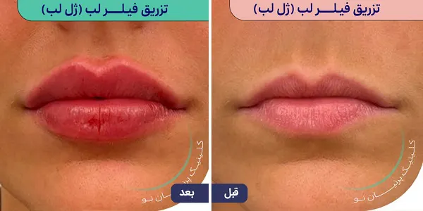 فیلر بهتر است یا بوتاکس | تفاوت تزریق بوتاکس و فیلر (ژل)