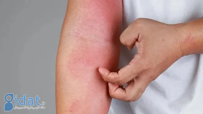 چگونه از شر خارش و التهاب در بهار خلاص شویم؟