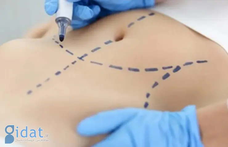 ابدومینوپلاستی؛ آیا شکم صاف و ایده آل ارزش این چالش را دارد؟