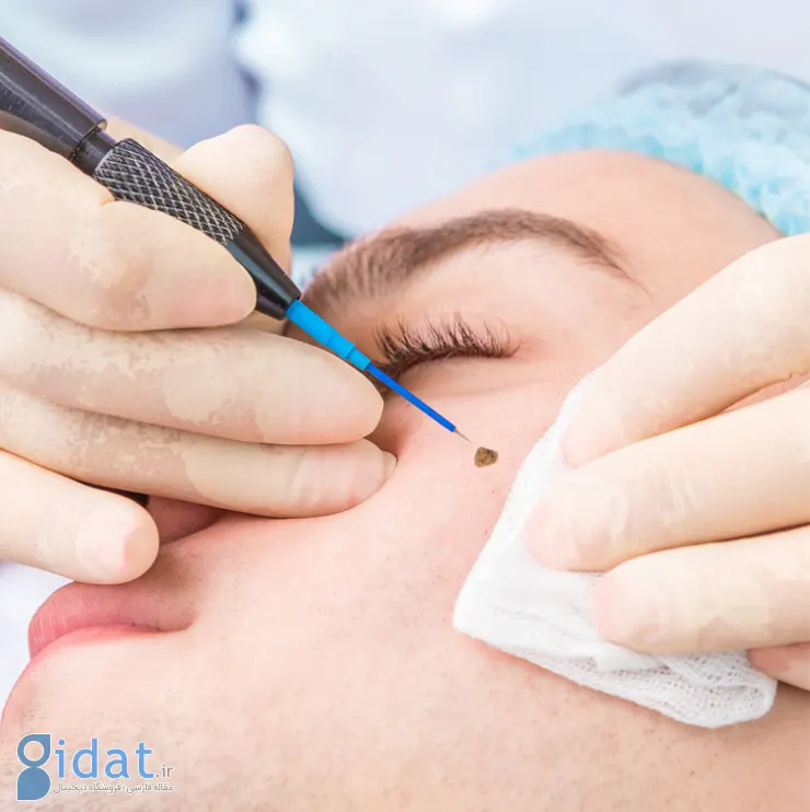 فریز کردن خال گوشتی چیست و چگونه انجام می شود؟