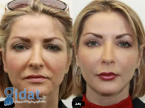 تزریق چربی در کرج با جدیدترین متدها + معرفی و بررسی کامل