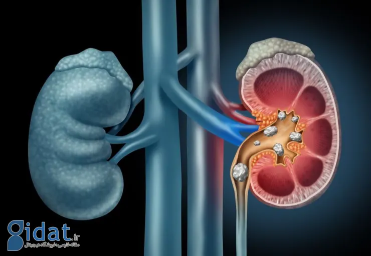 سنگ کلیه بیشتر در این افراد بروز می‌کند