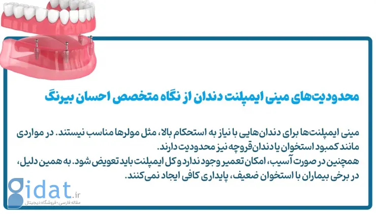 محدودیت‌ها و نکات مهم مینی ایمپلنت دندان از نگاه یک متخصص احسان بیرنگ