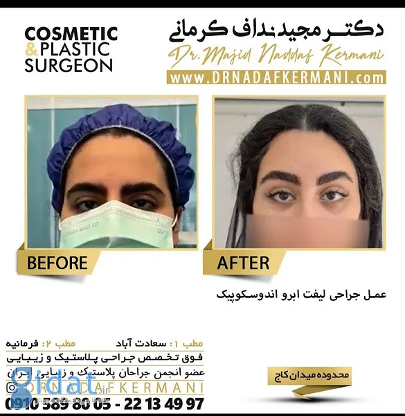 لیفت ابرو چیست و چگونه انجام می شود؟