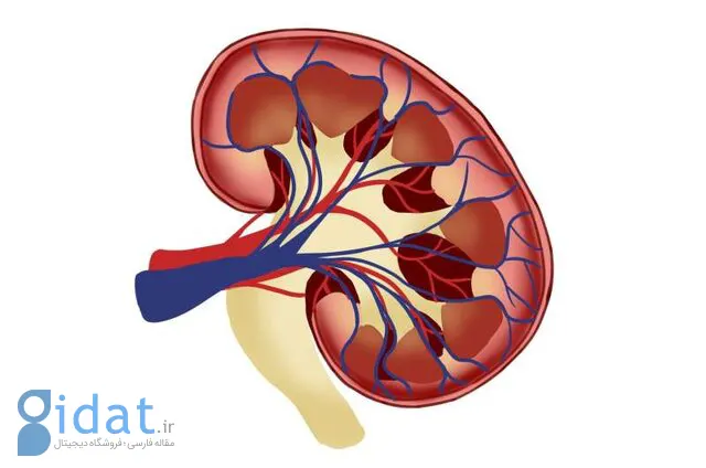 چگونه خطر ابتلا به سنگ کلیه را کاهش دهیم؟