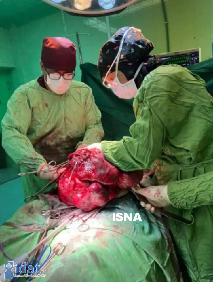تومور 11 کیلوگرمی از شکم یک بیمار در استان فارس خارج شد