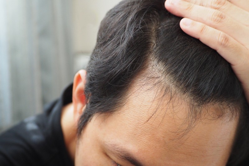 Supplements for hair loss in men