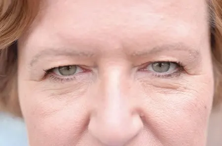 مشکلات رایج پلک که با افزایش سن ظاهر می‌شوند + درمان آنها