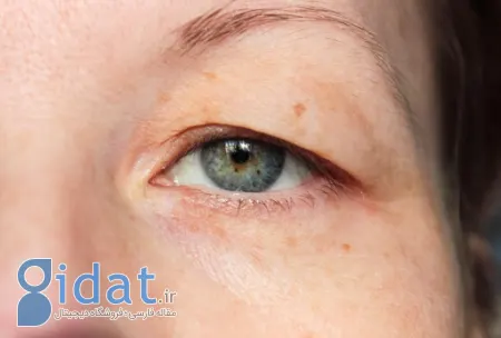 تغییرات در موقعیت پلک‌ها, علت پرش پلک چشم