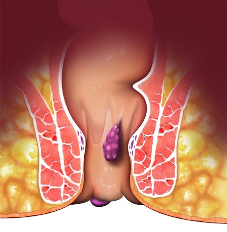 علل ، علایم و درمان بواسیر خارجی (هموروئید خارجی)