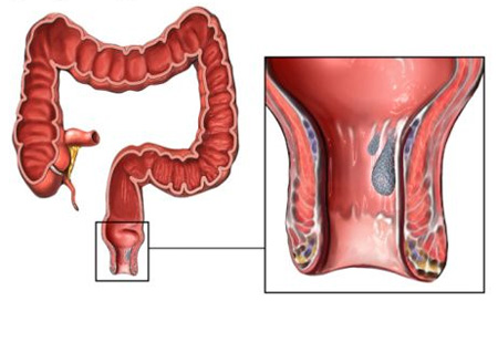علایم و درمان بیماری بواسیر داخلی
