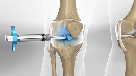 تزریق اسید هیالورونیک برای درمان آرتروز زانو