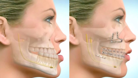 جراحی فک چه تاثیری بر چهره دارد؟