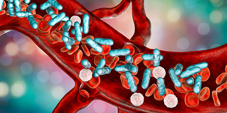 بیماری سپسیس چیست؟ علل ، علایم و درمان سپسیس