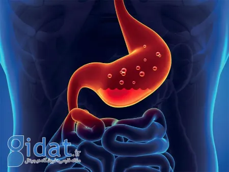 کمبود اسید معده, بتائین اچ سی ال