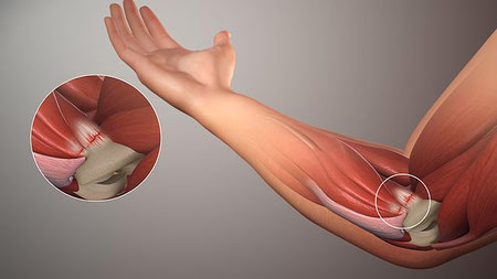 تاندونیت چیست؟ دلایل، علل و درمان تاندونیت