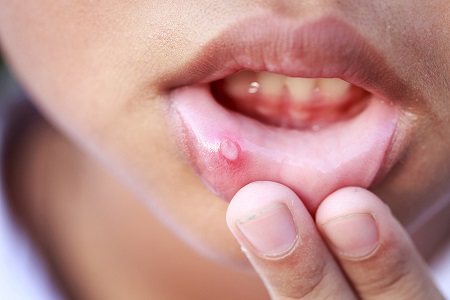 علل، علایم و درمان آفت دهان در کودکان