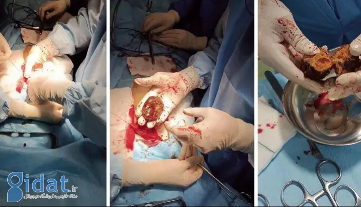 داستان دلهره آور «خرمالو» در اتاق های عمل!