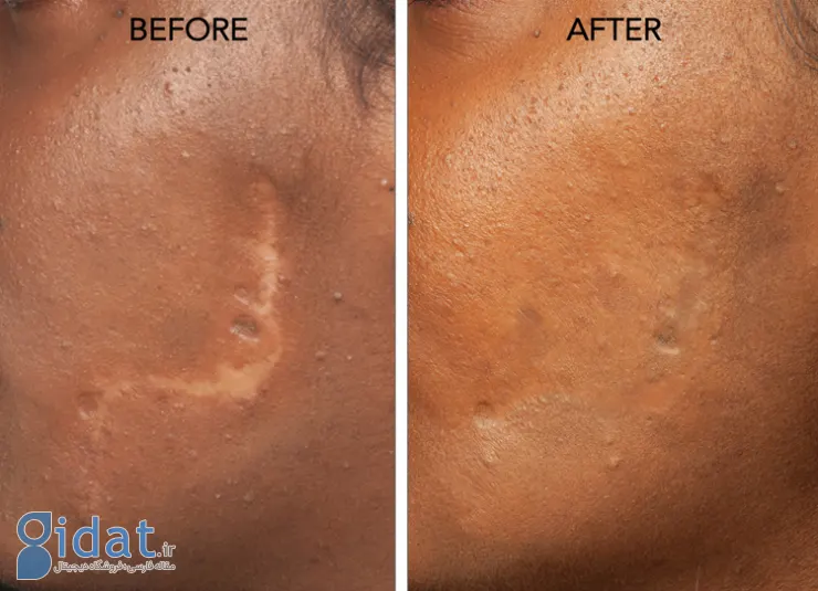 مزایای درمان جای زخم با سلول های بنیادی چیست؟