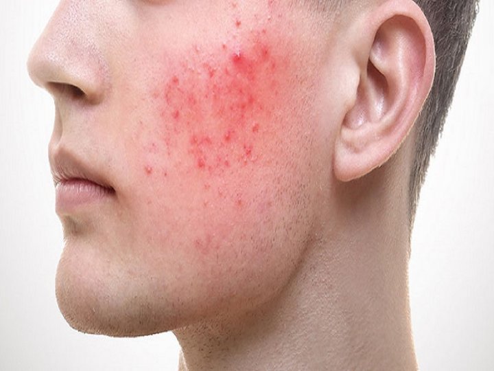 بیماری پوستی که در مردان شدید تر است