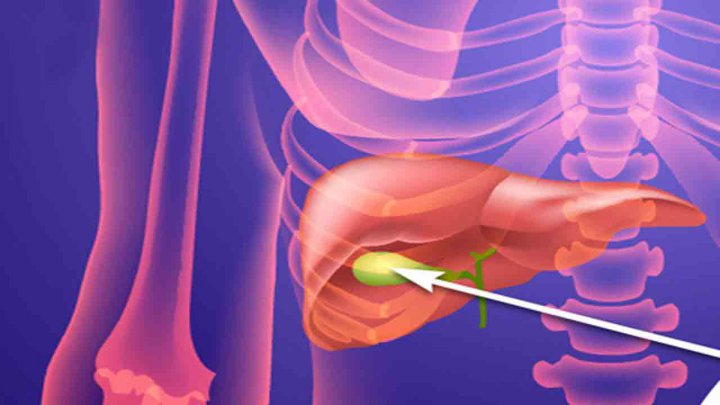 سنگ کیسه صفرا چه علائمی دارد؟ فیلم