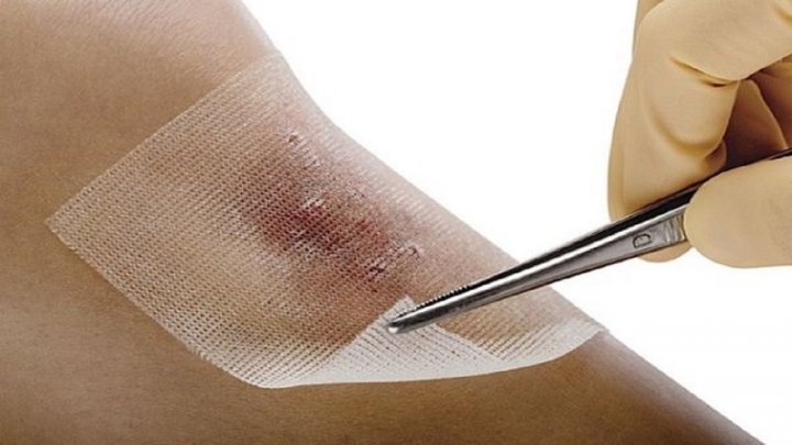 بومی سازی پانسمان زخم های دیابتی
