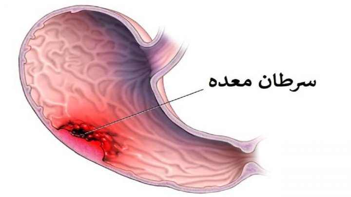 سرطان های دستگاه گوارش قابل پیشگیری هستند