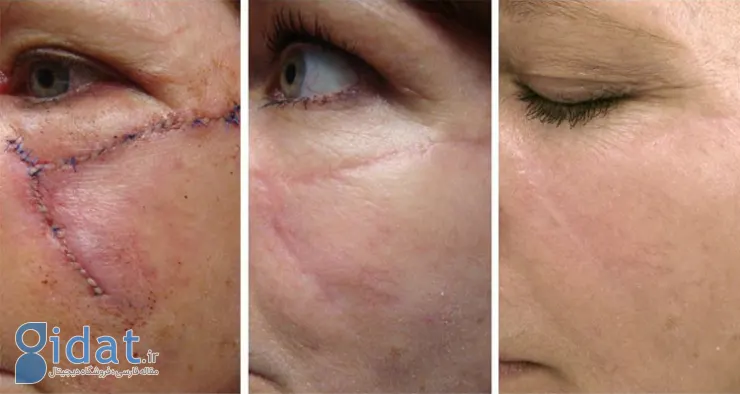 هزینه درمان جای زخم با سلول های بنیادی و لیزر