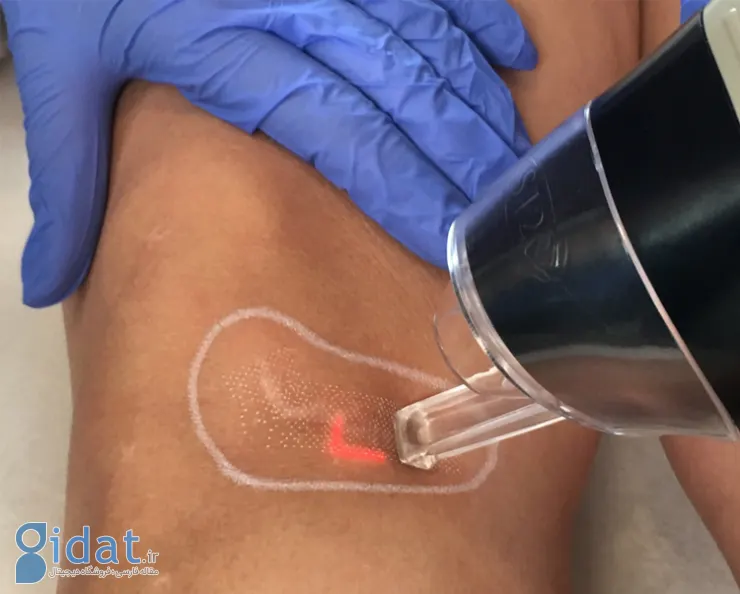 درمان جای زخم با لیزر چیست؟