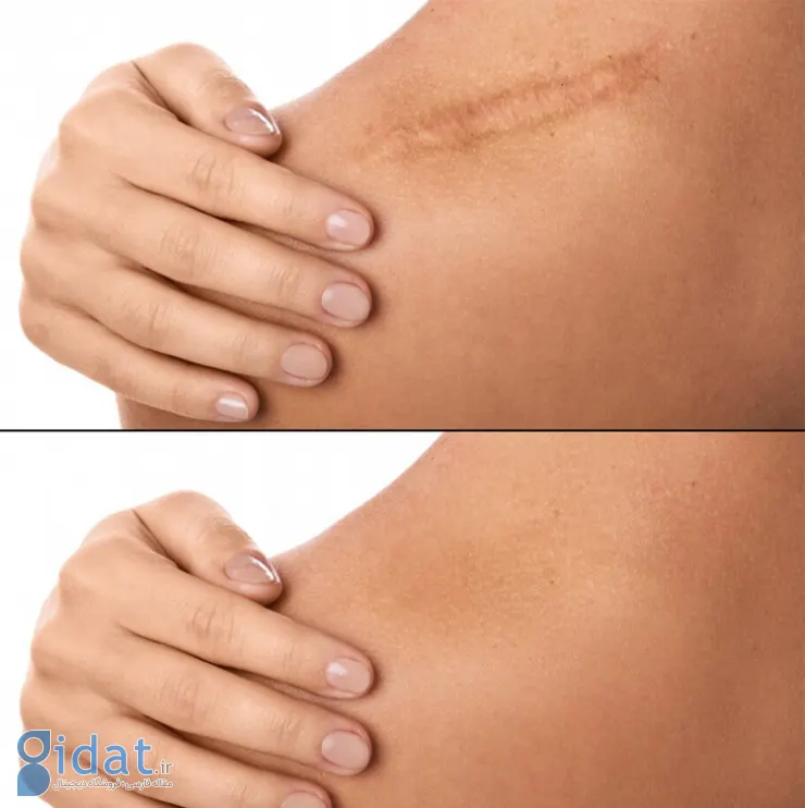 مقایسه درمان اسکار با سلول‌های بنیادی و لیزر؛ کدام موثرتر است؟