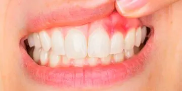 این علائم در دهان نشان دهنده سرطان است