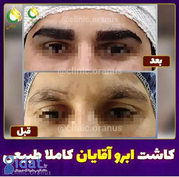 کاشت ابرو بدون جراحی چگونه انجام می شود؟