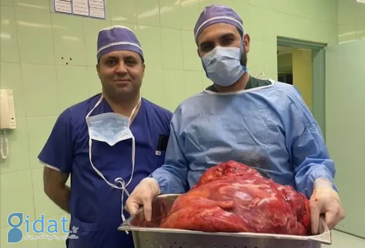 خارج کردن توده ۲۳ کیلویی از شکم خانم تبریزی